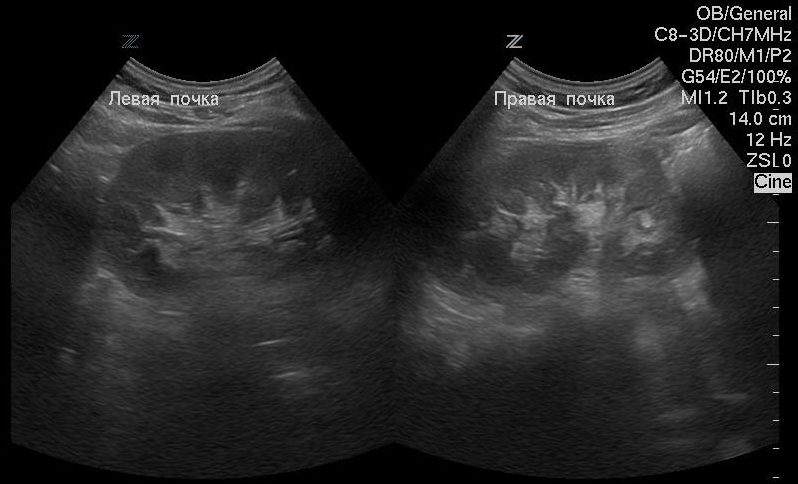 Узи почек картинка